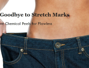 chemical peel for stretch marks