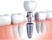 dental-implants